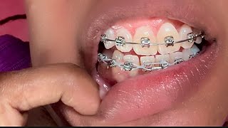 THE SCARY PART OF MY BRACES JOURNEY [upl. by Gabrielli]