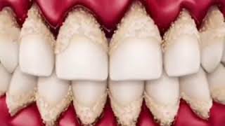 Gingivitis  Gum Disease  Wobbly Teeth [upl. by Porcia49]