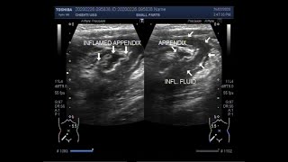 Ultrasound Video showing a leaked or ruptured Appendix [upl. by Ylil43]