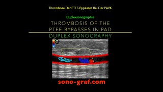 Duplexsonographie  Thrombose Des Bypasses Bei Der Peripheren Arteriellen Verschlusskrankheit [upl. by Kcinemod269]