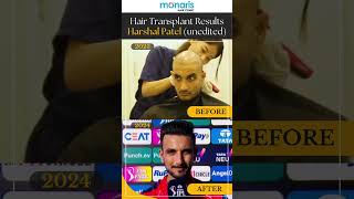 🧑Hair Transplant Results Harshal Patel [upl. by Almond]