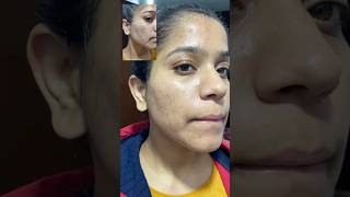 Tretinoin before and after 9month complete tretinoin face acne darkspots pimpleproblem [upl. by Ofelia]