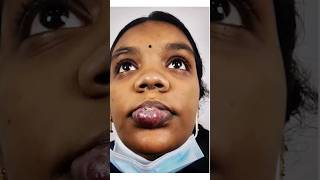 Hemangioma on Lower Lip [upl. by Kiryt]