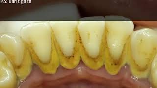 Ultimate Teeth Cleaning Treatment  Easy Tips for a Brighter Smile [upl. by Cul881]