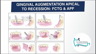 FREE CONNECTIVE TISSUE GRAFTS amp APICALLY POSITIONED FLAP GINGIVAL AUGMENTATION APICAL TO RECESSION [upl. by Malti]