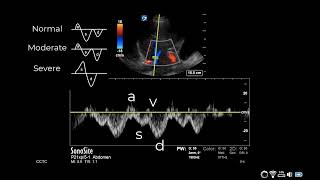 How to Obtain a Hepatic Vein Waveform [upl. by Ahsielat]