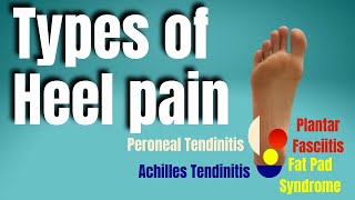 Types of Heel Pain  San Diego Sports Chiropractic [upl. by Draned208]