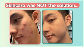 Confused sa pag treat ng ACNE Start here Beginners Guide  Jan Angelo [upl. by Georgia]