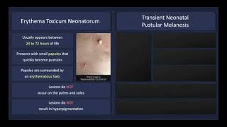 Transient neonatal pustulosis vs erythema toxicum neonatorum Dermatosis of infancy dermatology [upl. by Tammara]