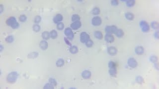 Malaria parasite plasmodium falciperum gametocyte in thick and thin blood smear in microscopic slide [upl. by Birkle888]