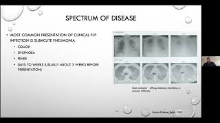 Pneumocystis jirovecii pneumonia  Current Issues in its Management [upl. by Ellinger]