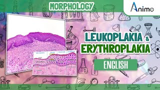 Leukoplakia and Erythroplakia  GIT Morphology  English [upl. by Ole]