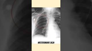 Westermark sign  Pulmonary Embolism [upl. by Wagoner]