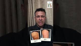 Dr Hasan August Cellulite Treatment [upl. by Enajiram]