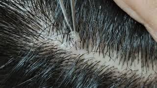 Relaxing dandruff removal w tweezers 15 02sleepyheads  visual ASMR oddlysatisfying [upl. by Yentrok]