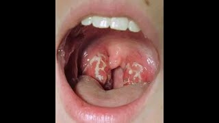 2 simple and fast home remedies for tonsils that works fast [upl. by Yelik]