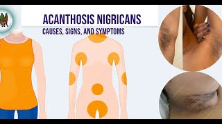 Acanthosis Nigricans Causes Signs and Symptoms [upl. by Vivi]