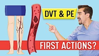 DVT Animation Deep Vein Thrombosis and Pulmonary Embolism PE Memory Tricks for Exams NCLEX [upl. by Ahsuoj461]