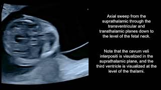 The prevalence and evolution during the firsttrimester of the cavum veli interpositi [upl. by Ettinger]