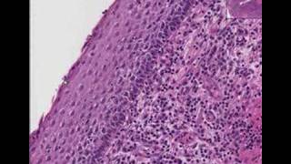 Histopathology Cervix  Squamous cell carcinoma [upl. by Bradway]