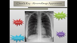 Chest XRay Abnormal Image Appearances [upl. by Holmann983]