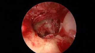 Endoscopic Transcanal Excision of Otic Capsule Schwannoma [upl. by Felise]