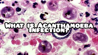 What is acanthamoeba infection  Summary [upl. by Arahk]