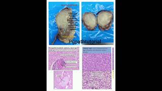 Crisp summary of congenital mesoblastic nephroma a NTRK positive tumor [upl. by Solohcin]