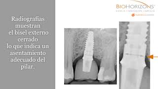 Tecnologia Spiralock BioHorizons [upl. by Oznerol]