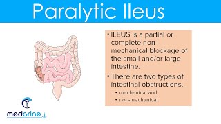 Paralytic Ileus  causes pathophysiology clinical features diagnosis and treatment [upl. by Atsylac]