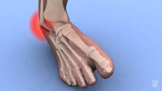 Mayo Clinic Minute Ankle sprains 101 [upl. by Eceerehs]