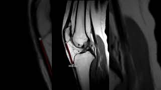 Patella alta and fatty impingement [upl. by Agbogla]