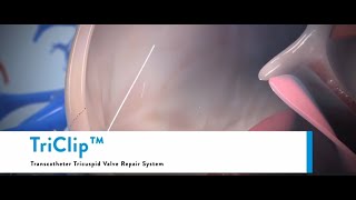 Triclip Transcatheter Tricuspid Valve Repair System  Tricuspid valve regurgitation [upl. by Loring131]