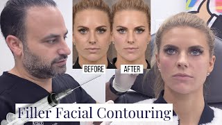 Beverly Hills Facial Fillers  Los Angeles Cosmetic Jawline and Neckline Improvement  Dr Ben Talei [upl. by Soilisav]