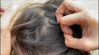 Nits amp lices picking killed Removal ASMR challenge 💯 how to kill nits in hair [upl. by Laks]