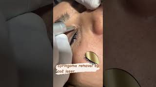 SYringoma removallaser treatmentlaserco2laser [upl. by Nagle]