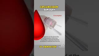 Understanding Circumcision Animated Surgery amp Real Insightsquot [upl. by Ayahsey]