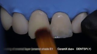 Practical course Direct restoration of anterior teeth [upl. by Rodavlas]