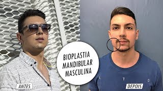 Tudo sobre Bioplastia Mandibular Masculina  Antes e Depois [upl. by Head]