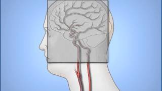 Diagnostic Cerebral Angiography [upl. by Elleinod]