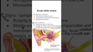 Acute otitis media [upl. by Aidyn]