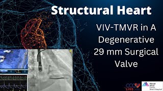 VIVTMVR in A Degenerative 29 mm Surgical Valve [upl. by Nore]