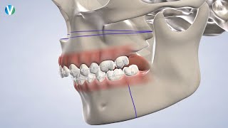 Jaw Surgery in Ventura CA  Greater Ventura Oral amp Facial Surgery [upl. by Malek568]