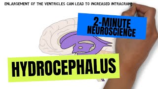 2Minute Neuroscience Hydrocephalus [upl. by Nywg198]