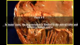 Myxomatous degeneration Top  7 Facts [upl. by Lias]