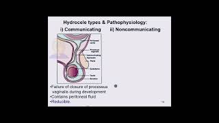 Communicating vs Noncommunicating hydrocele [upl. by Serolod]