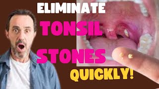 3 Effective Home Remedies for Tonsil Stones That Provide Rapid Relief Tonsilloliths [upl. by Somisareg]