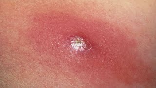 how to get rid of boils under the armpit permanently [upl. by Marijn688]