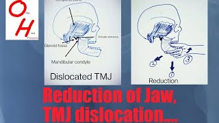 How to reduce a Temporomandibular TMJ Jaw dislocation [upl. by Ettolrahc]