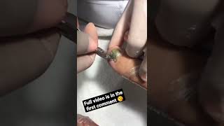 Removing a old toenail full of mycosis and fungus 👣 satisfying [upl. by Damalis684]